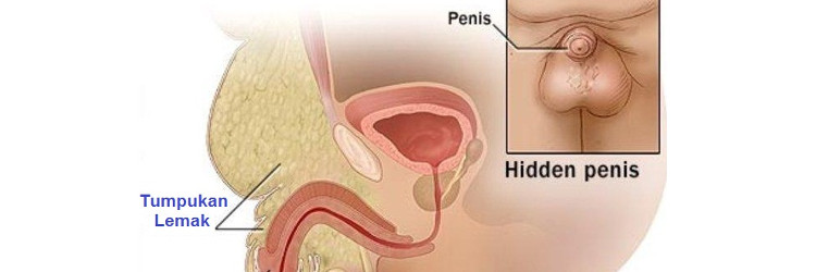 kidney stone disease 1